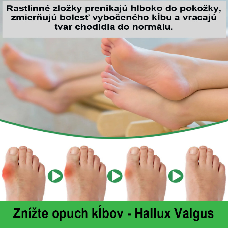 Prírodná náplasť na Hallux Valgus - vybočení palec 5ks